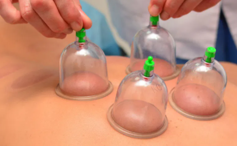 Professional Dry & Korean Cupping Therapy Diploma Course