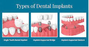 Виды имплантов зубов